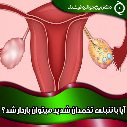 آیا با تنبلی تخمدان شدید میتوان باردار شد
