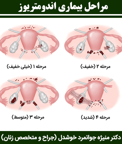 مراحل-بیماری-اندومتریوز