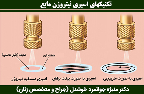 تکنیکهای-اسپری-نیتروژن-مایع
