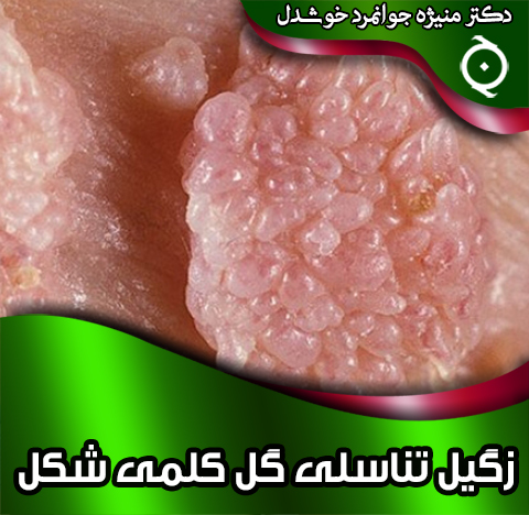 زگیل-تناسلی-گل-کلمی-شکل