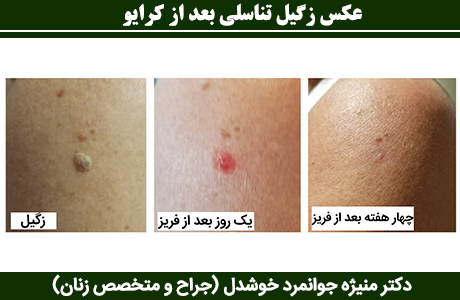 آیا کرایوتراپی زگیل تناسلی درد دارد؟