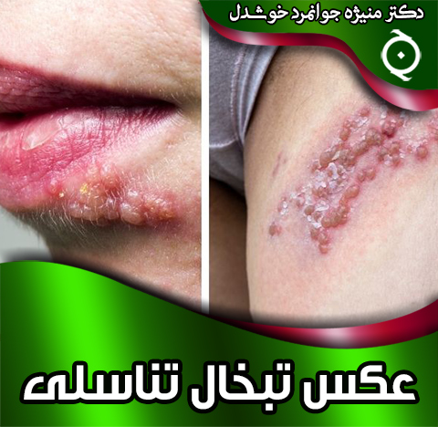 عکس-تبخال-تناسلی
