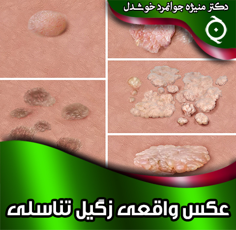 عکس-واقعی-زگیل-تناسلی